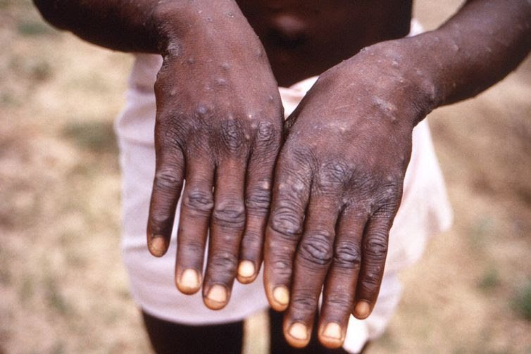 Sintomas da doença incluem erupções na pele | Foto: Agência Brasil - None