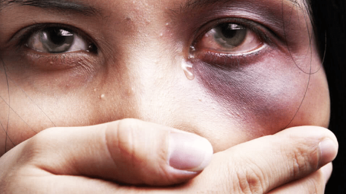 Leis que protegem mulher: mulher com o olho roxo - Divulgação