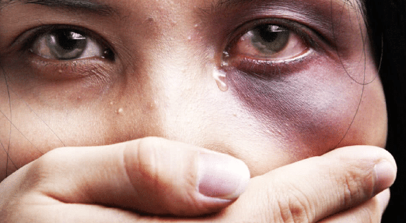 Mulher machucada após sofrer violência doméstica - Getty Images/iStockphoto