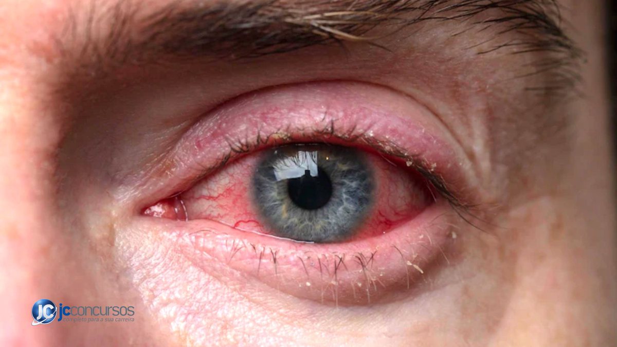 Irritação nos olhos: maior tempo de exposição às telas pode provocar uma  doença; saiba como identificar