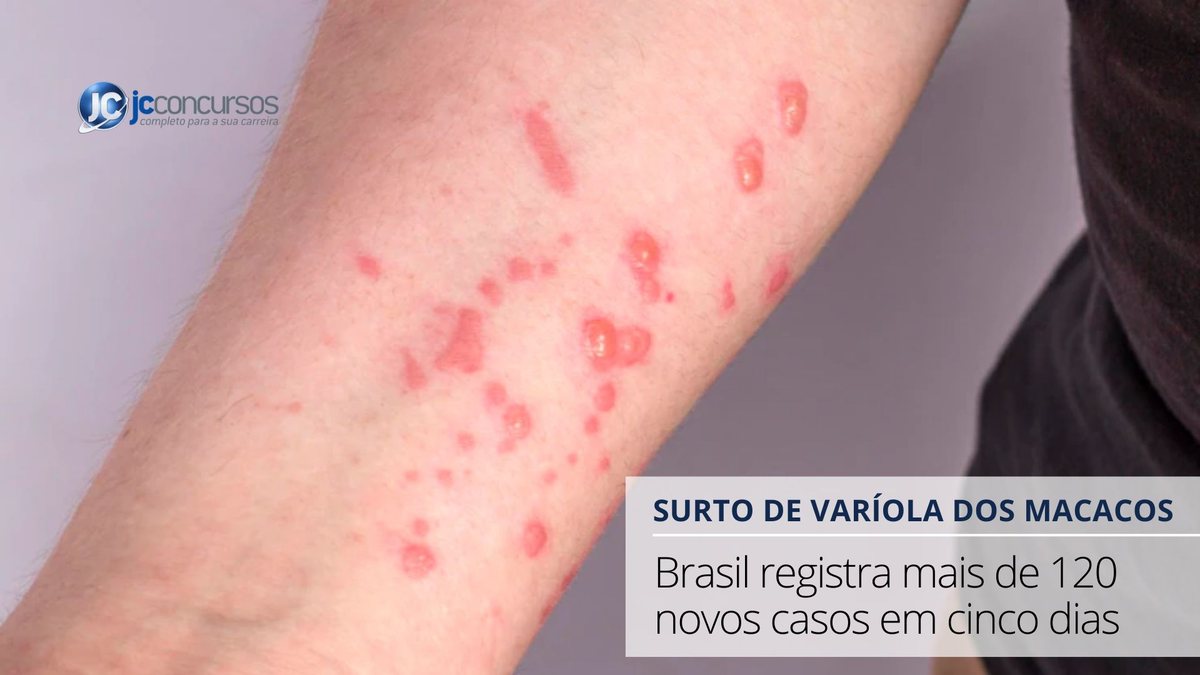 Pessoa com lesões no braço em decorrência da contaminação pelo vírus da varíola dos macacos | Foto: Freepik - None