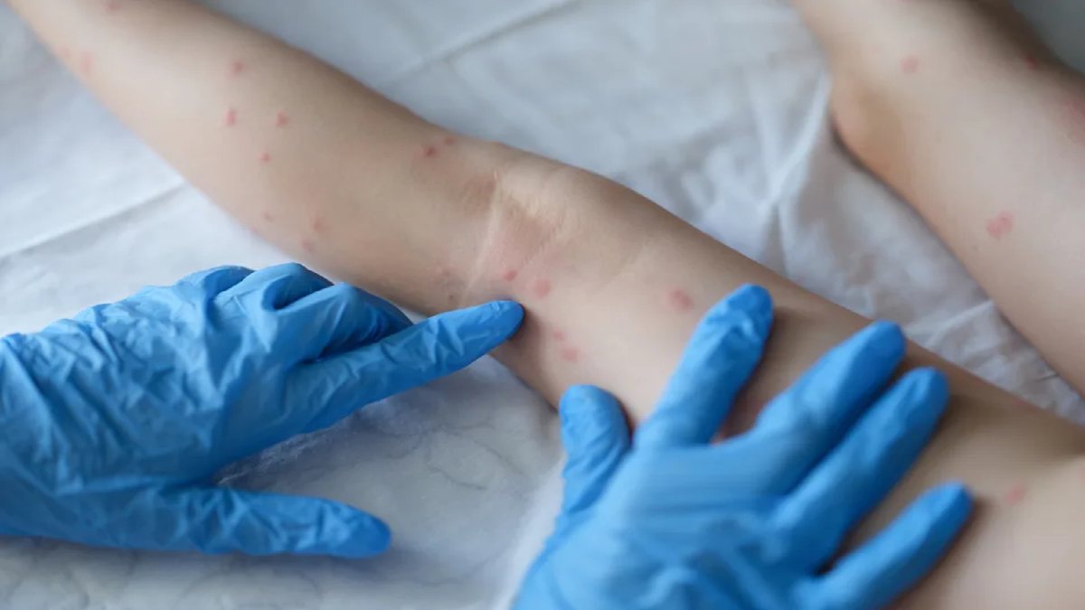 Transmissão da varíola dos macacos de humano para humano ocorre principalmente através da saliva e pus de lesões - Getty Images