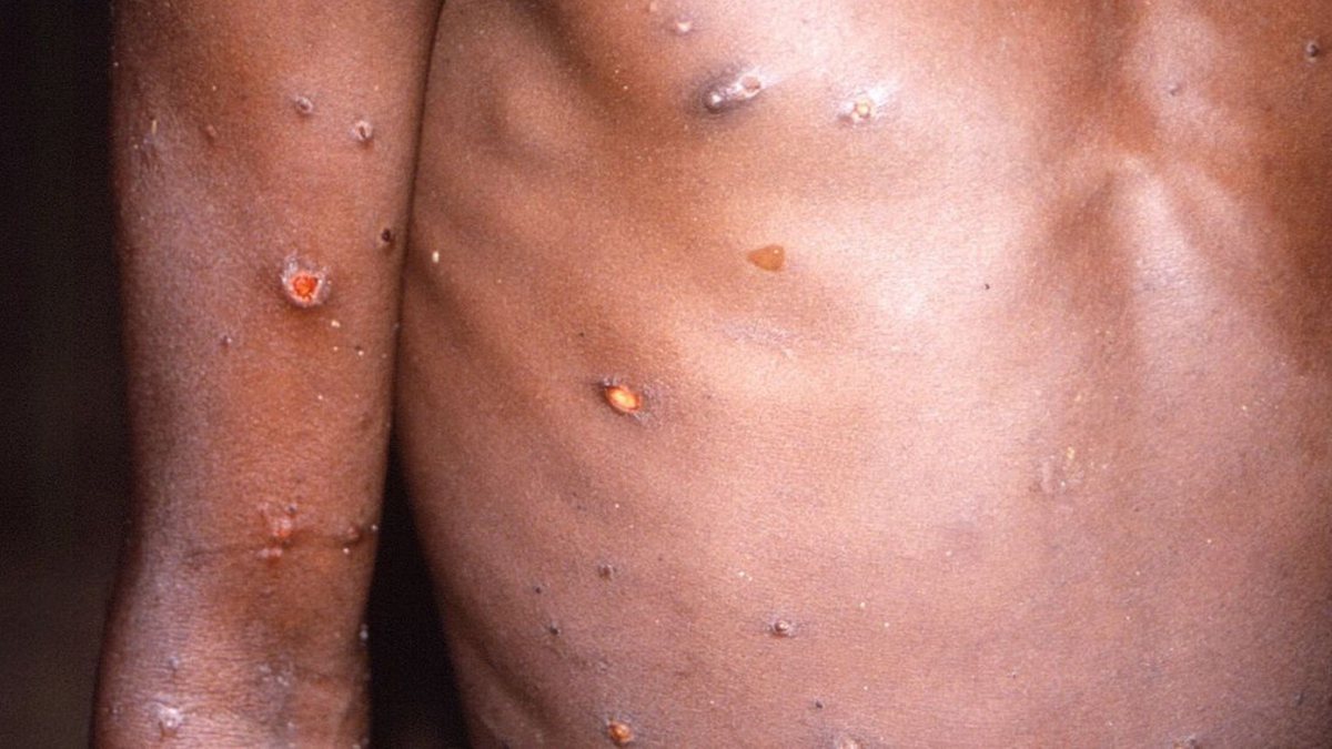 Homem com erupções cutâneas após infecção com a 'varíola dos macacos'