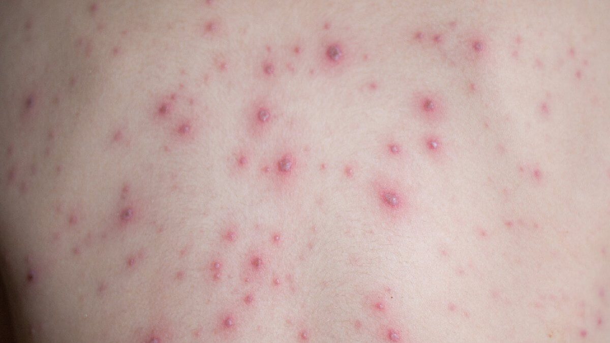 Grávidas que tiveram caso de varíola dos macacos descartado devem ficar em isolamento por 21 dias - Shutterstock
